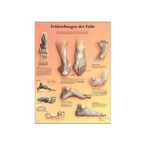   Deformities of The Feet Anatomical Chart, German), Poster Size 20