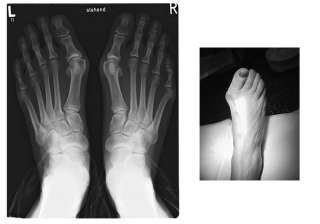   shoes have been helping those people suffering from bunions hallux